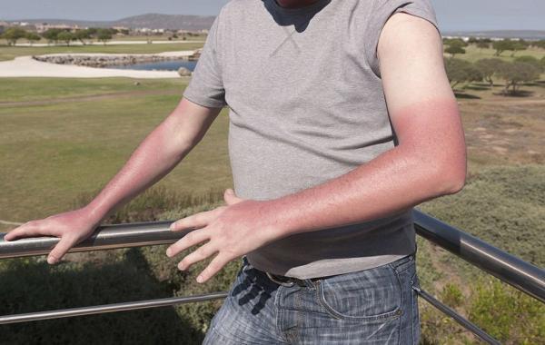 10 اشتباه رایج که عوارض آفتاب سوختگی را تشدید می نمایند